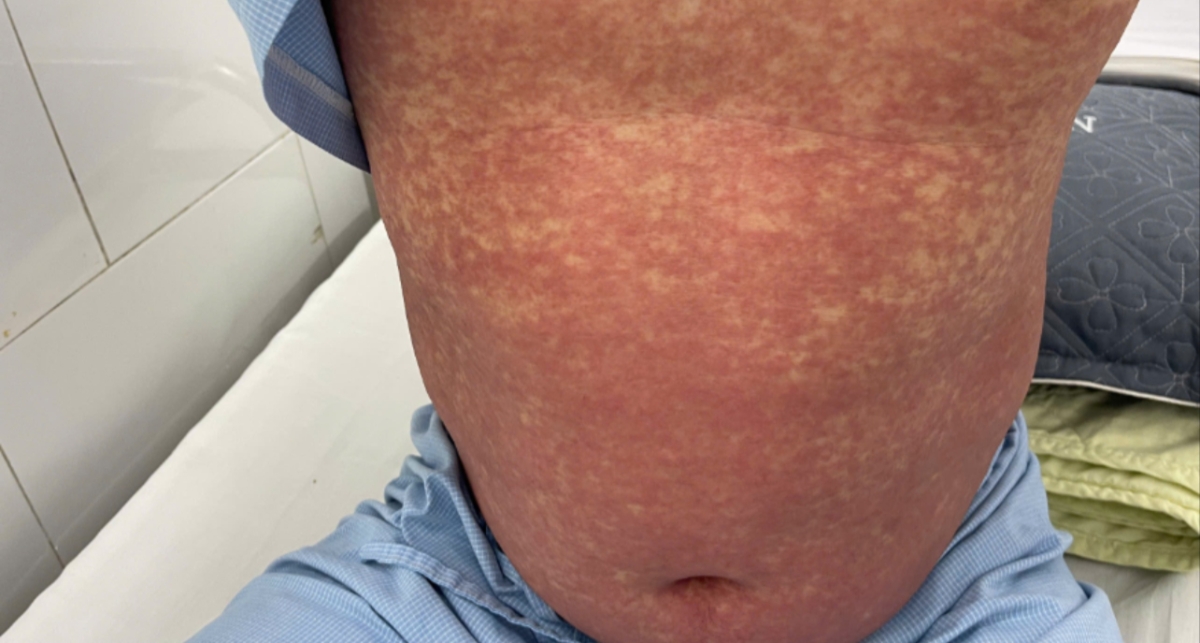 Hình ảnh phát ban toàn thân trên bệnh nhân đang được điều trị.