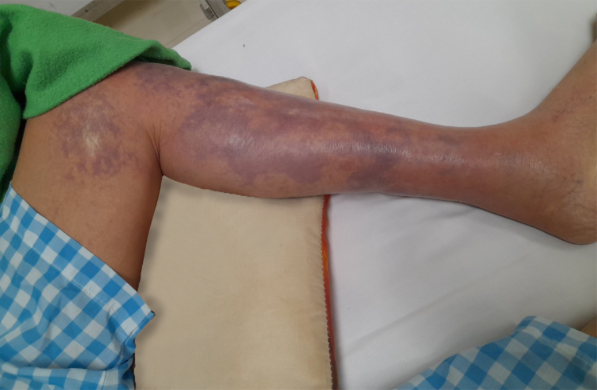 Viêm cân mạc hoại tử&nbsp; là một dạng nhiễm trùng mô mềm hiếm gặp.