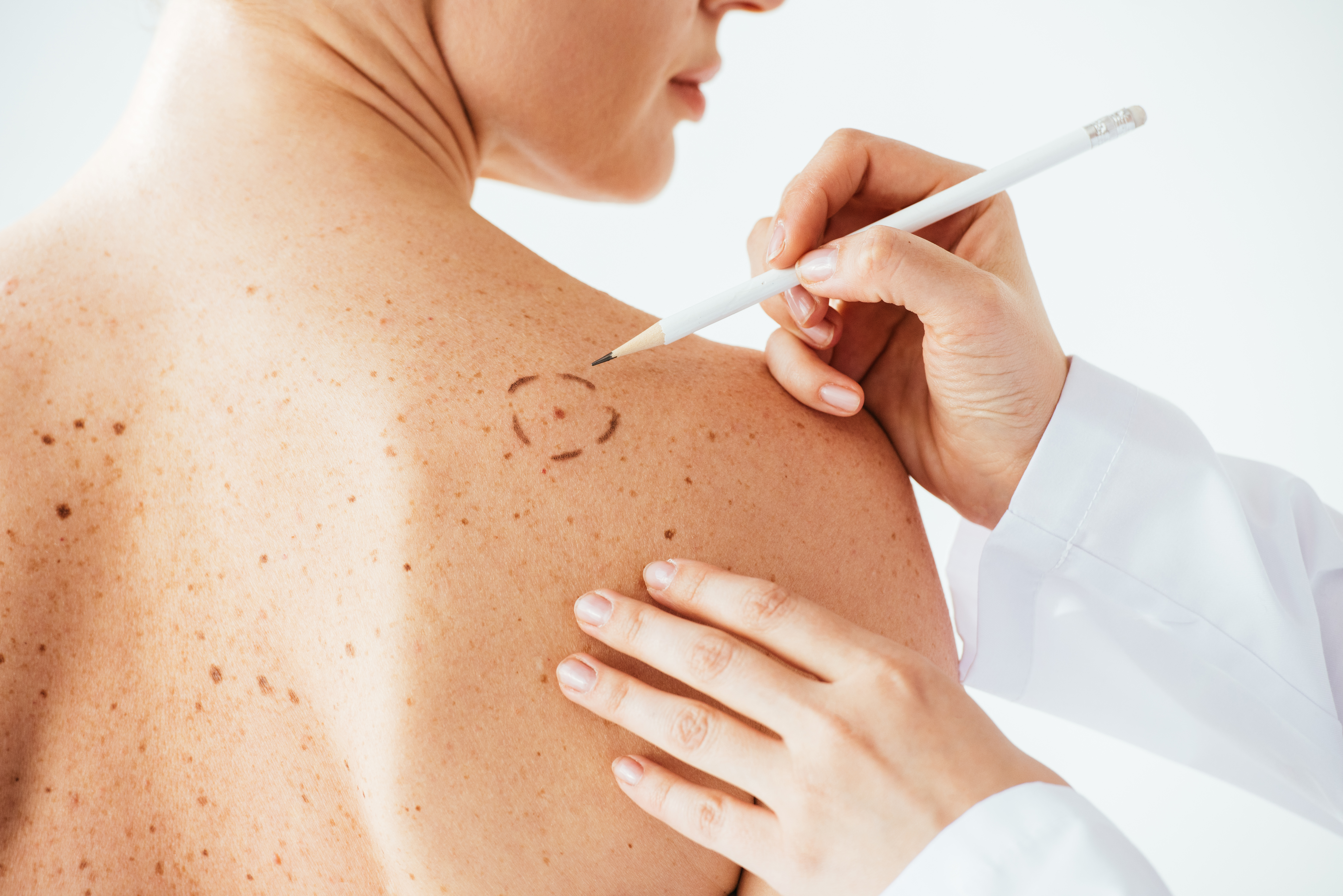 Nên dùng kem chống nắng phổ rộng SPF 30 trở lên mỗi ngày, kể cả khi trời nhiều mây.