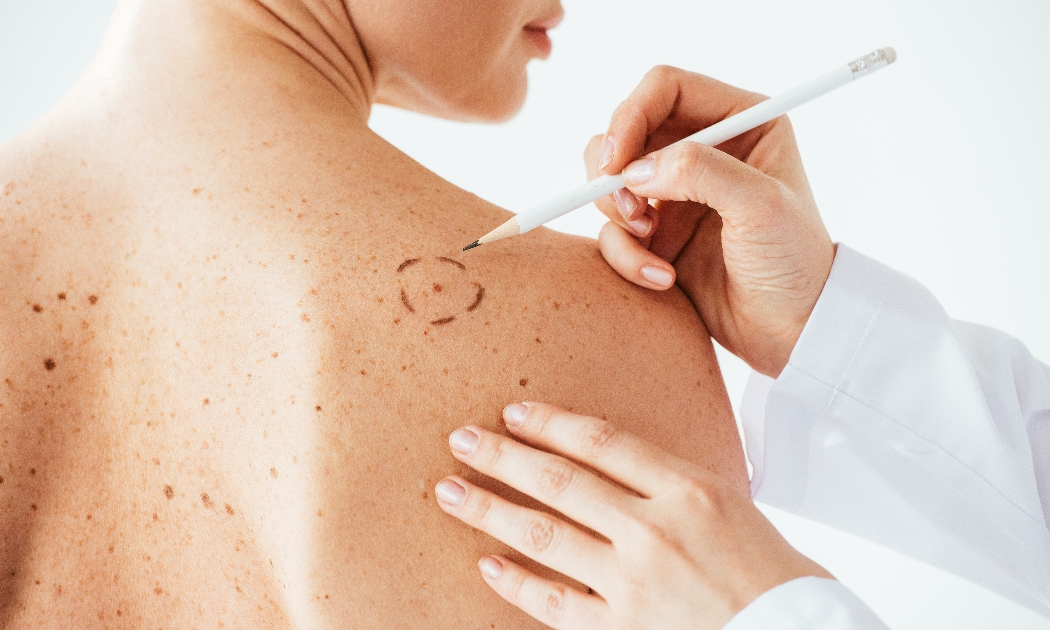 Nên dùng kem chống nắng phổ rộng SPF 30 trở lên mỗi ngày, kể cả khi trời nhiều mây.