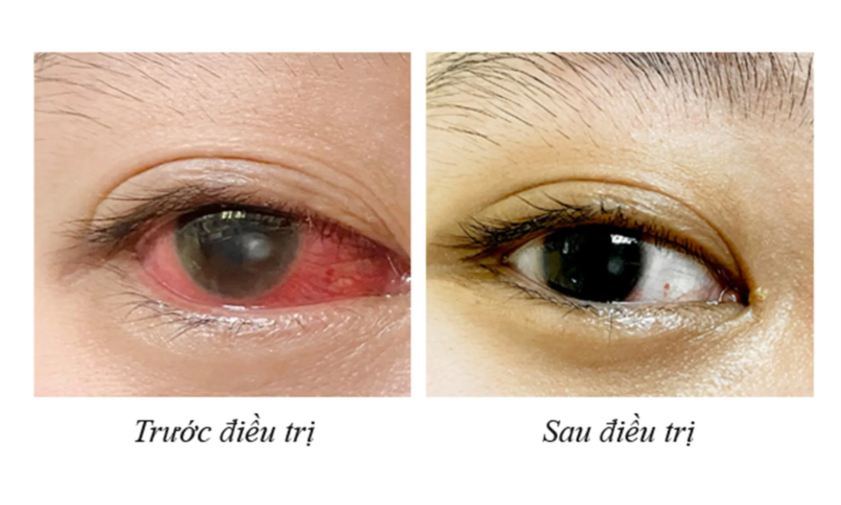 Mắt của bệnh nhân trước và sau khi điều trị tại&nbsp;Bệnh viện Việt Nam - Thụy Điển Uông Bí.