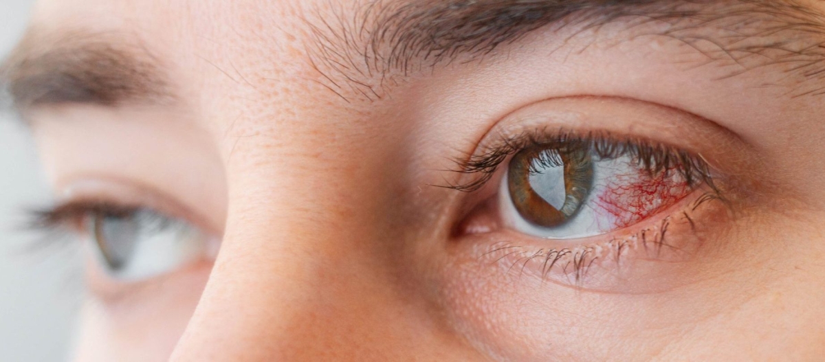 Viêm loét giác mạc có thể dẫn đến mất thị lực.&nbsp;