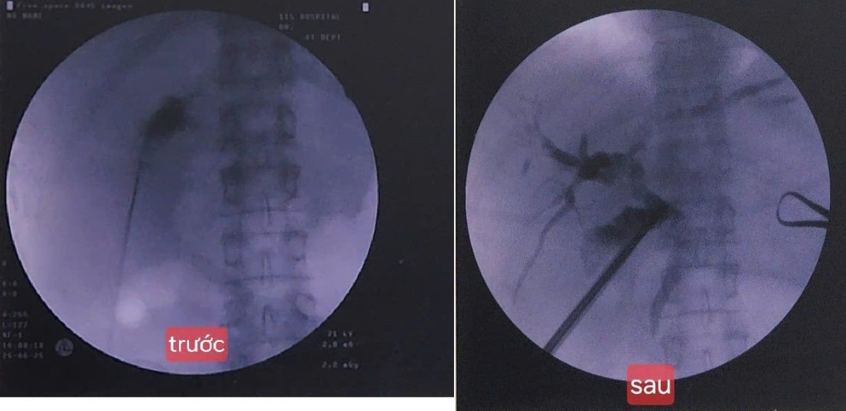 Hình ảnh trước và sau khi bệnh nhân được&nbsp; tán sỏi túi mật xuyên gan qua da.
