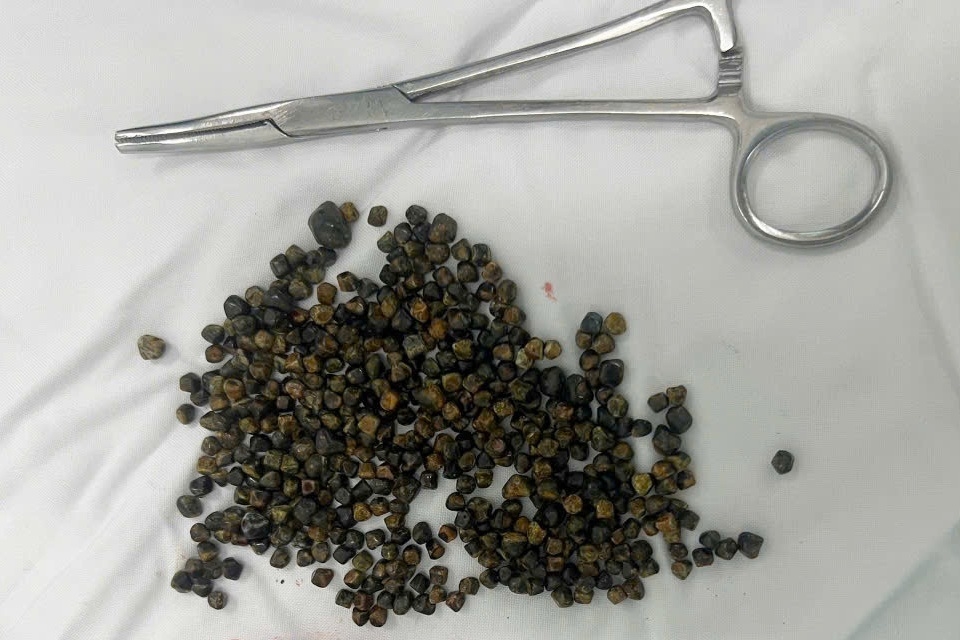 Trước khi được bác sĩ lấy 481 viên sỏi khỏi túi mật, nữ Việt kiều đã có 2 lần điều trị thất bại.