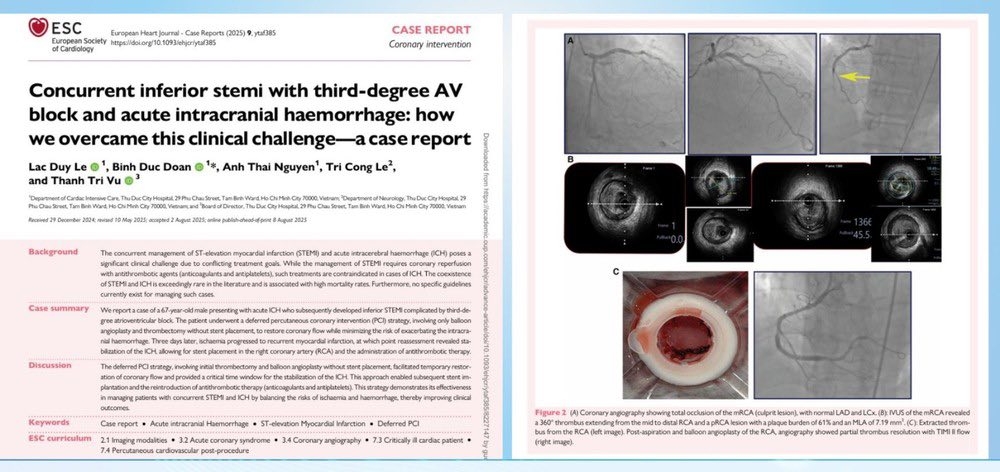 Ca bệnh hiếm tại Việt Nam được đăng tải trên&nbsp;tạp chí y khoa thuộc Hội Tim mạch châu Âu.