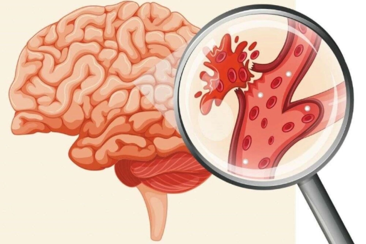 Tăng huyết áp có thể gây gây nhồi máu não, xuất huyết não.