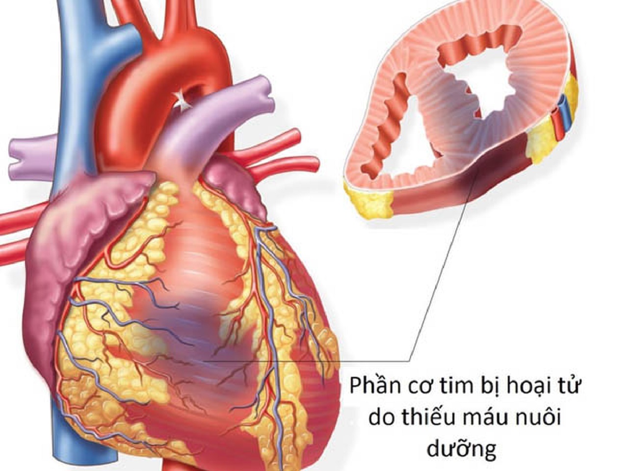 Trong ca bệnh hiếm, nhồi máu cơ tim cần thuốc chống đông và kháng tiểu cầu, trong khi xuất huyết não lại chống chỉ định.