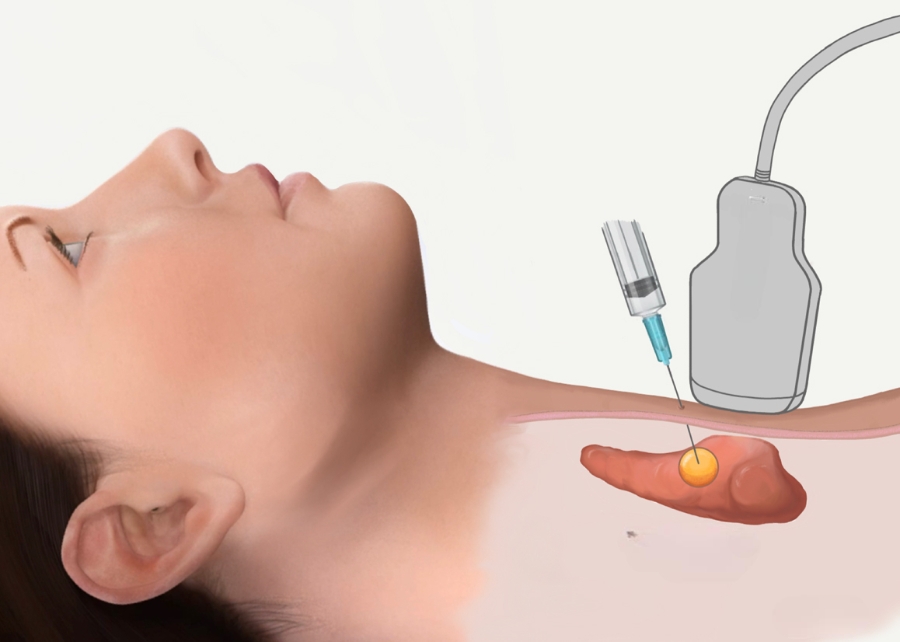 Nếu thực hiện ở cơ sở không phép, nguy cơ biến chứng rất lớn như viêm tuyến giáp, liệt dây thanh quản...