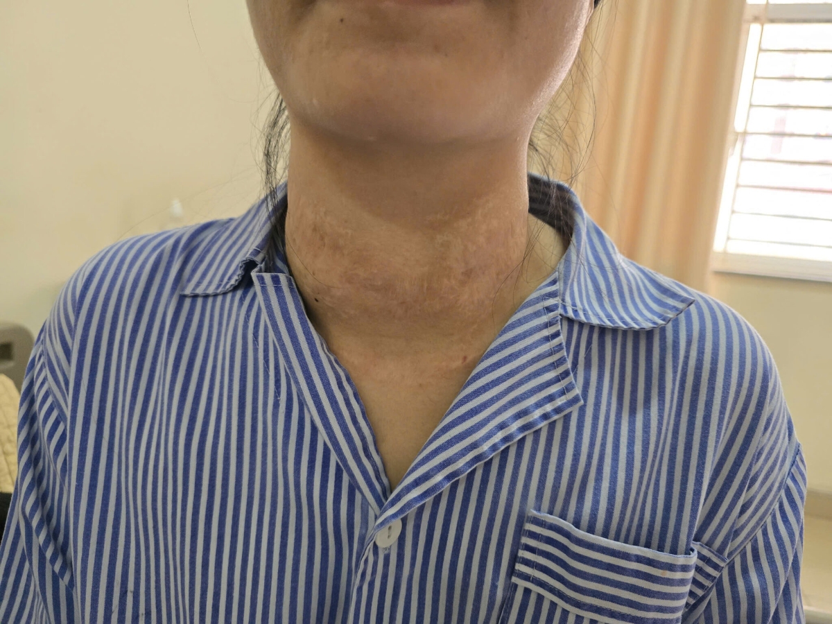 Bệnh nhân này&nbsp;là một trong những bệnh nhân điển hình phải gánh chịu hậu quả nặng nề từ các phương pháp điều trị không chính thống. 