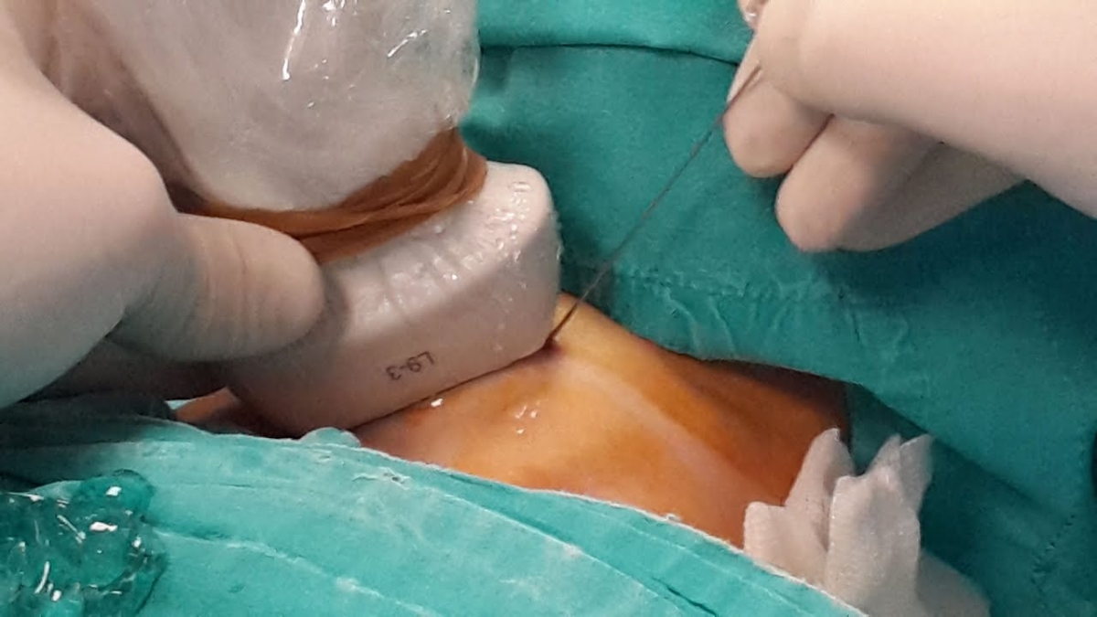 Tiêm ethanol vào nhân tuyến giáp phải được tiến hành nghiêm ngặt dưới hướng dẫn siêu âm tại bệnh viện chuyên khoa.&nbsp;