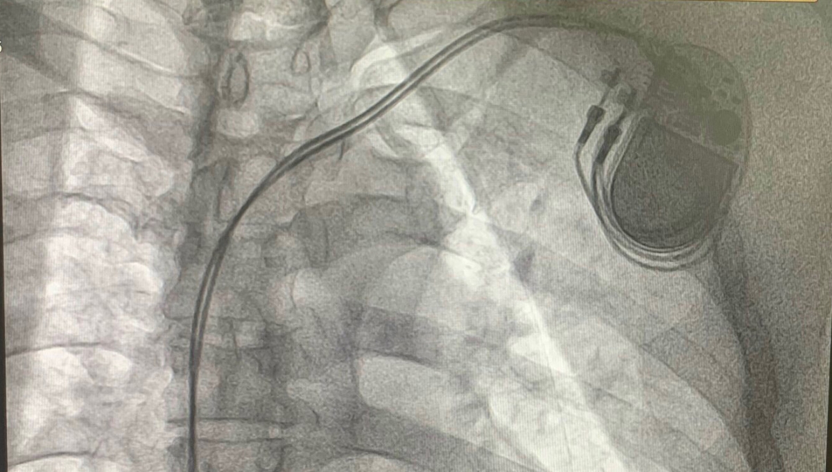 Máy tạo nhịp vĩnh viễn là một thiết bị hỗ trợ tạo nhịp tim, được sử dụng trong các trường hợp rối loạn nhịp tim nặng, trong đó phổ biến nhất là rối loạn nhịp tim chậm và nghẽn dẫn truyền tim.