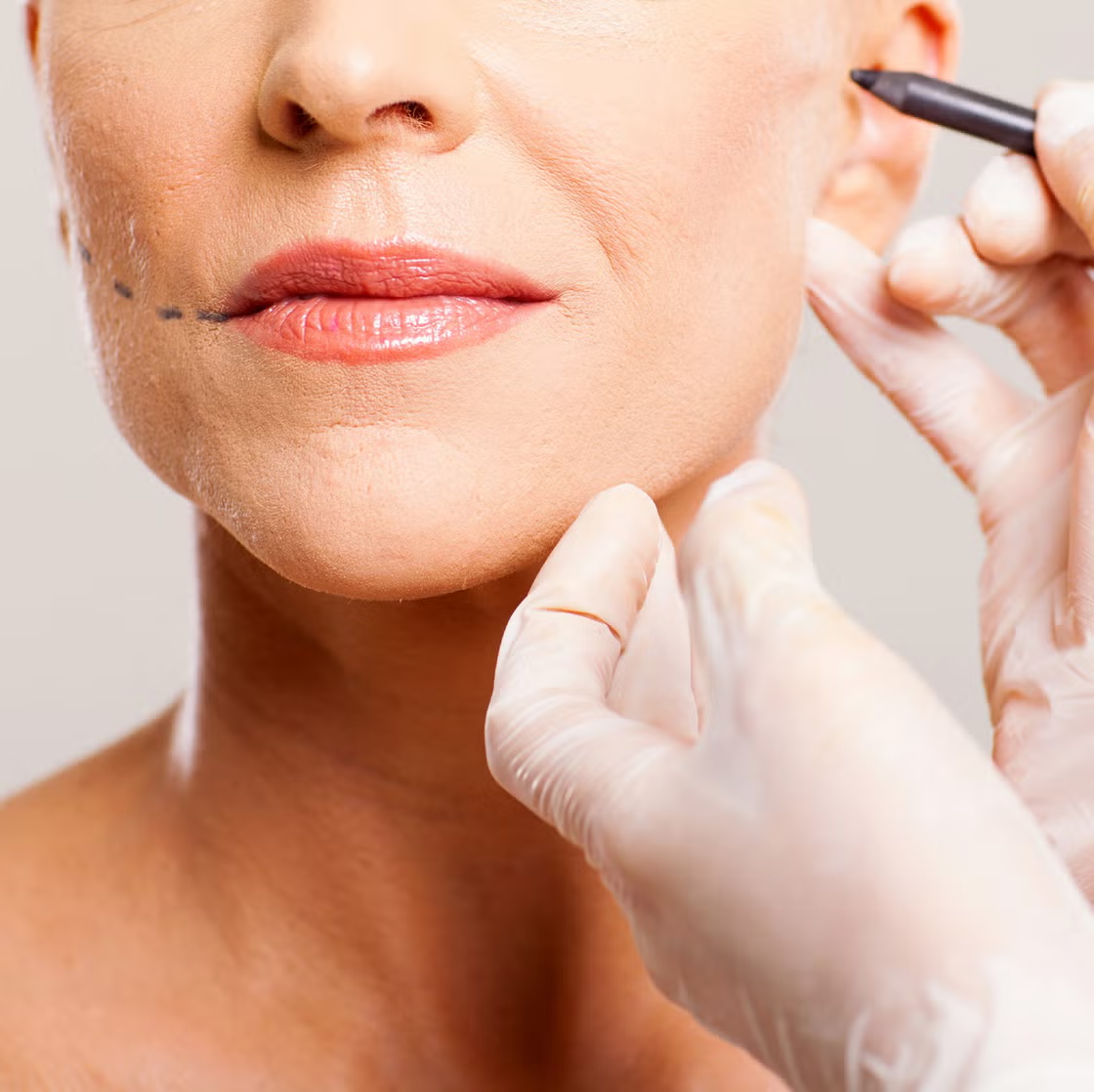 Ngày nay, một ca căng da mặt thành công là sự tổng hòa của nhiều kỹ thuật.