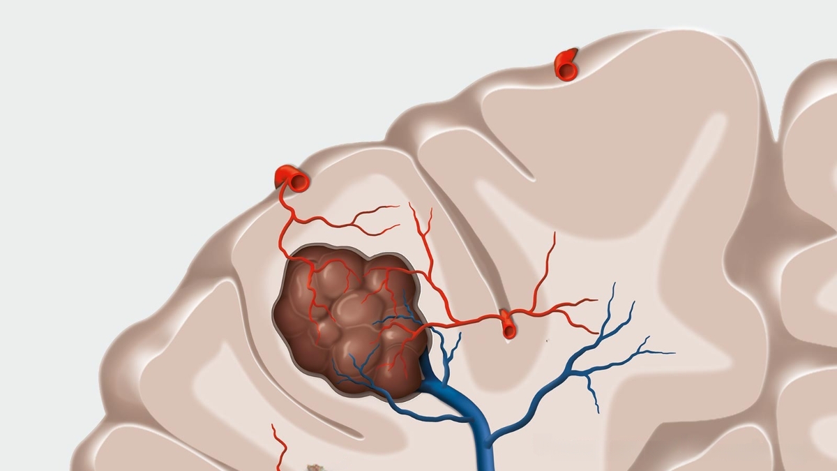 Nguyên nhân dị dạng mạch máu não thường là do bẩm sinh và phát triển trong quá trình hình thành thai nhi.