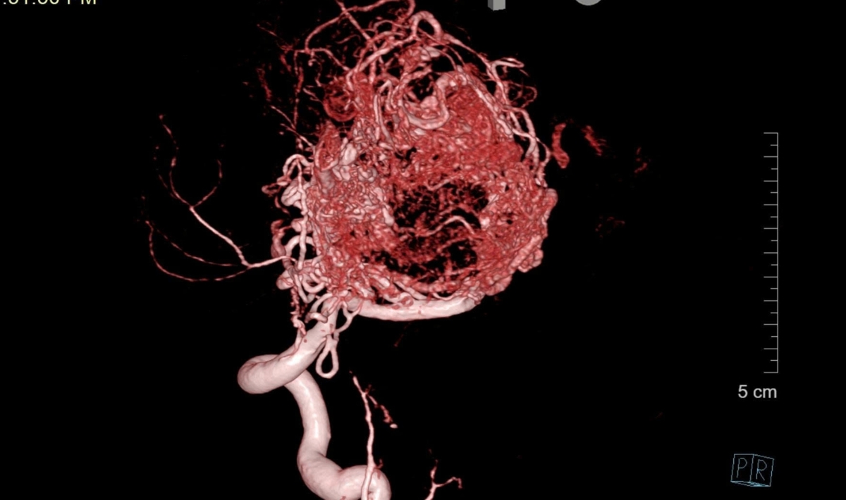 Ổ dị dạng mạch máu não của nam sinh K. được hiển thị bởi thiết bị DSA.&nbsp;