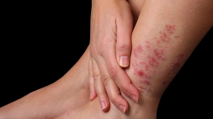 Để phòng bệnh, bác sĩ khuyến cáo người dân khi phải tiếp xúc với nước bẩn cần mang ủng, găng tay bảo hộ.