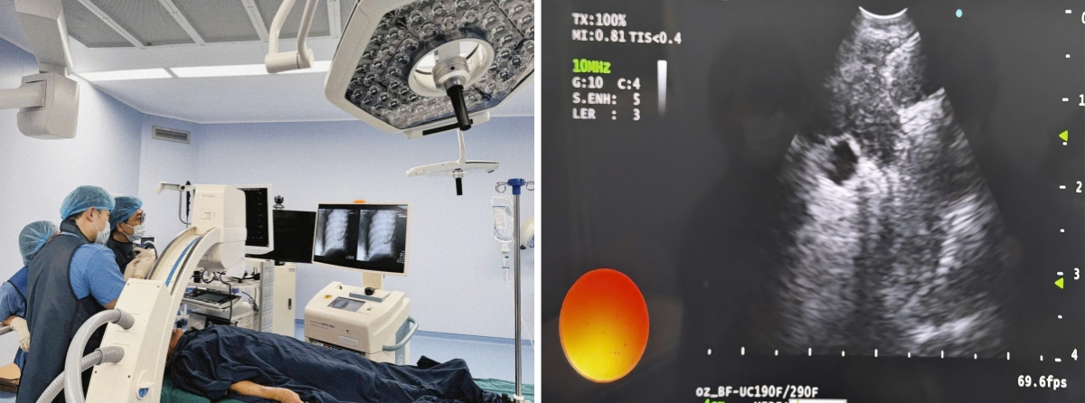 Hìnhảnh các bác sĩ đang tiến hành EBUS-IFB cho bệnh nhân và hình ảnh kim sinh thiết trong hạch bạch huyết được quan sát trên hình ảnh siêu âm.&nbsp;&nbsp;