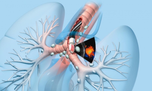 Bước phát triển mới của kỹ thuật nội soi hô hấp Việt Nam