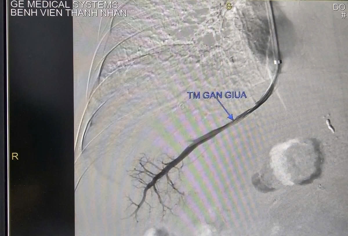 Hình ảnh cho thấy một phần độ khó của ca can thiệp này.