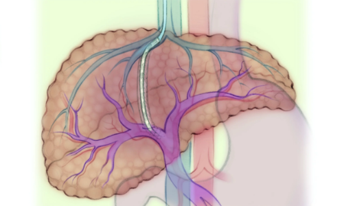 “Phao cứu sinh” cho bệnh nhân xơ gan