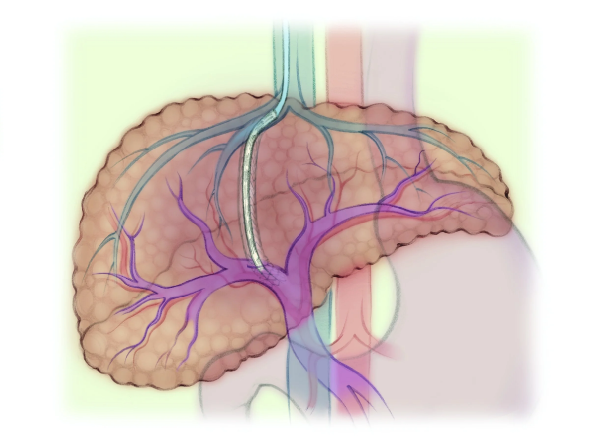 TIPS là kỹ thuật xâm lấn tối thiểu chỉ định cho bệnh nhân xơ gan mất bù.