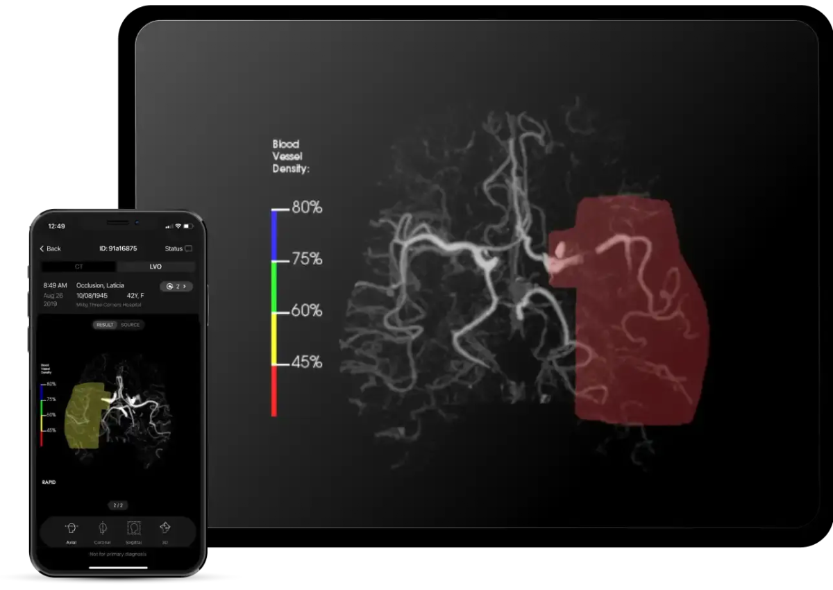 Phần mềm RAPID tại Bệnh viện Nhân dân 115&nbsp; đã hỗ trợ chẩn đoán cho hơn 5.000 bệnh nhân.