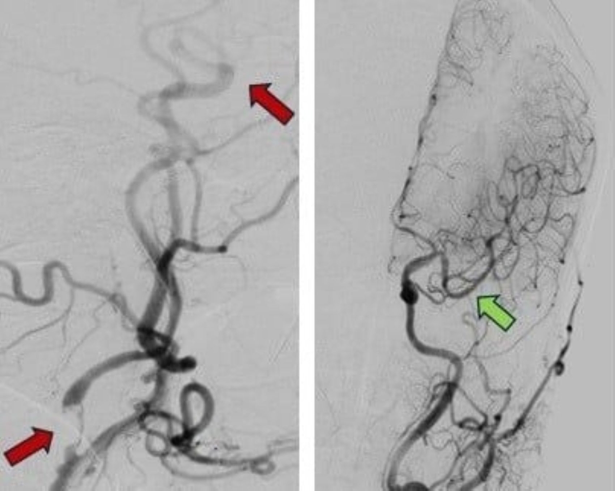Hình ảnh mạch máu bị tắc gây đột quỵ (mũi tên đỏ) và sau khi được tái thông hoàn toàn (mũi tên xanh). Ảnh: Bệnh viện Nhân dân 115.