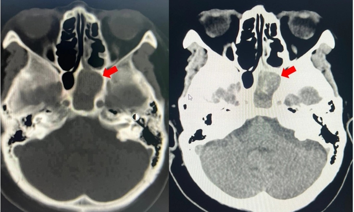 Hình ảnh khối nấm xoang bướm bên trái (mũi tên đỏ) của bệnh nhân 67 tuổi.