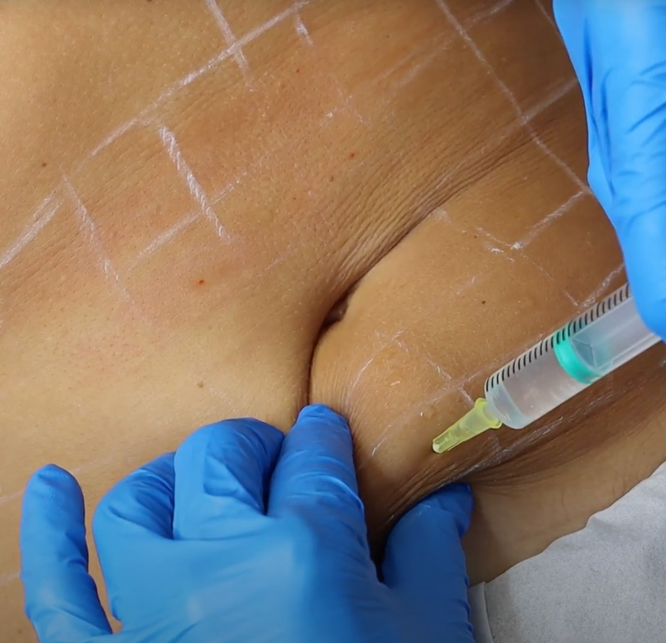 Một trong những sai lầm nghiêm trọng của các cơ sở thẩm mỹ “chui” là việc tiêm thuốc gây tê không kiểm soát.