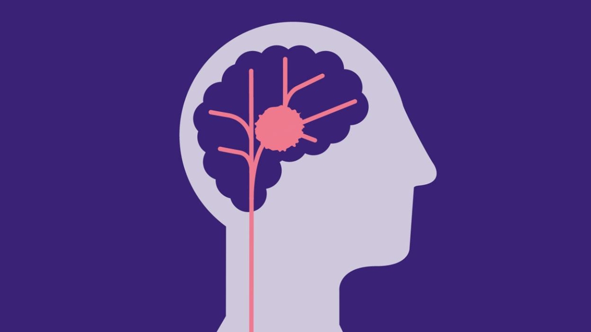 Đột quỵ đang có xu hướng trẻ hóa, nhiều trường hợp xảy ra ở người dưới 35 tuổi.