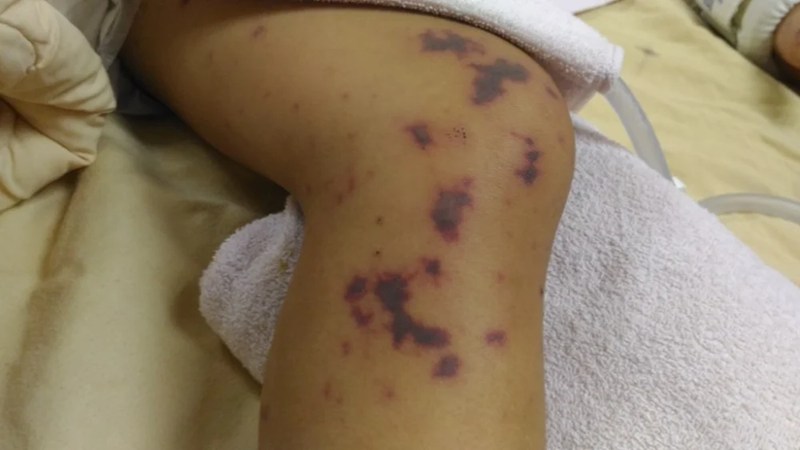 Hà Nội mới đây ghi nhận thêm 1 ca mắc não mô cầu tại xã Thường Tín. 