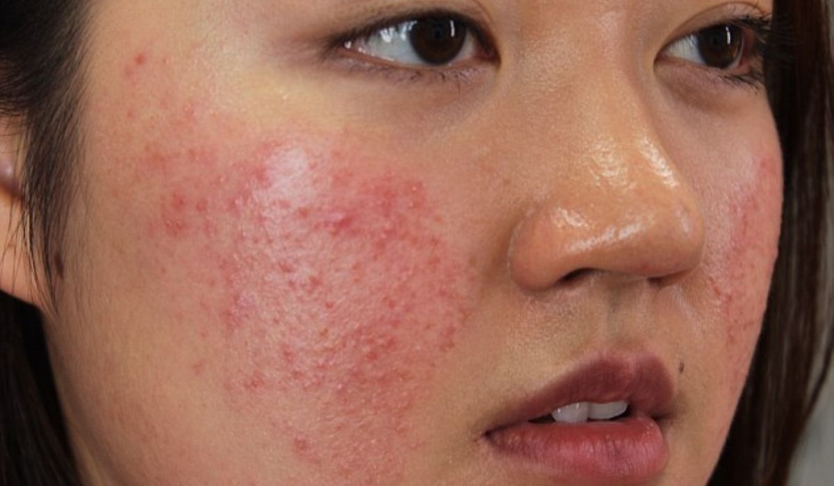 Mỹ phẩm chất lượng kém&nbsp;chứa nhiều hoạt chất nguy hiểm khiến làn da hư hỏng nặng.