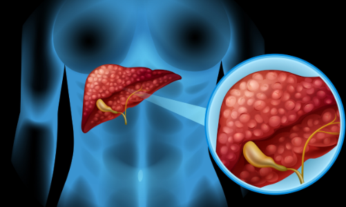 Men gan “kêu cứu” do chữa bệnh theo kinh nghiệm dân gian
