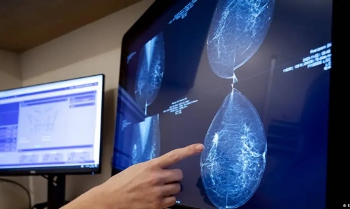 Mô hình AI mới dự đoán nguy cơ ung thư trong 5 năm