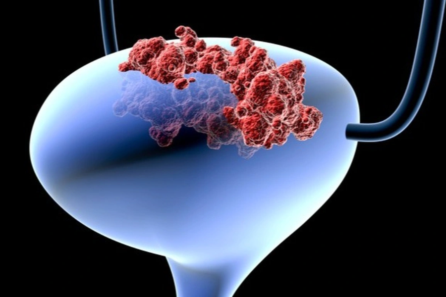 Tỷ lệ nam giới mắc ung thư bàng quang cao gấp 3 - 4 lần nữ giới.