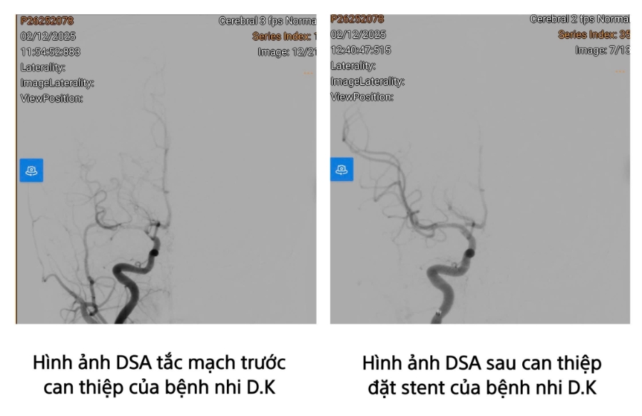 Căn bệnh vốn được coi là của người lớn xuất hiện ngày càng nhiều ở người trẻ tuổi, với biểu hiện không rõ ràng nhưng diễn biến đột ngột và đặc biệt nguy hiểm.