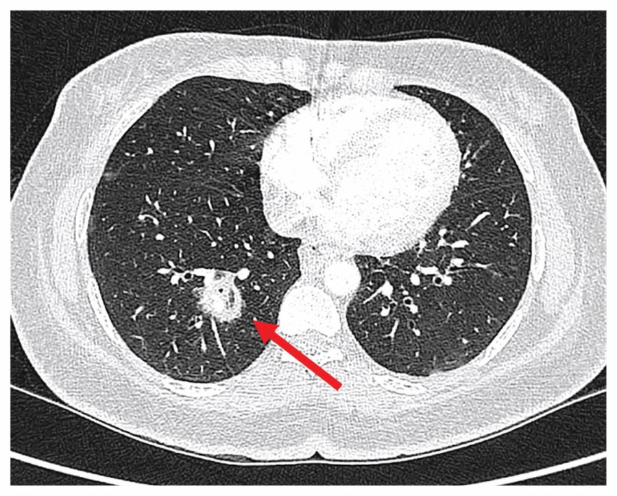 Nấm xâm lấn thường gặp nhất ở người đái tháo đường, đặc biệt khi kiểm soát đường máu kém.