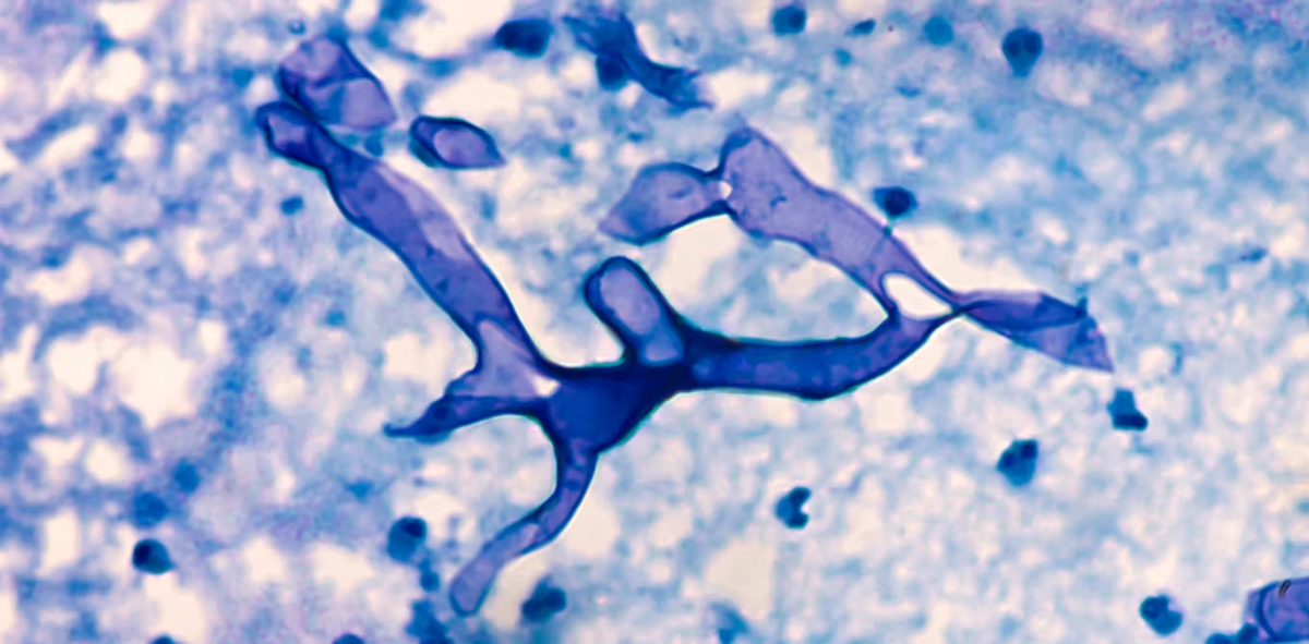 Nấm đen thường gặp ở người có bệnh nền nhưng cũng có thể xảy ra ở người khỏe mạnh.&nbsp;