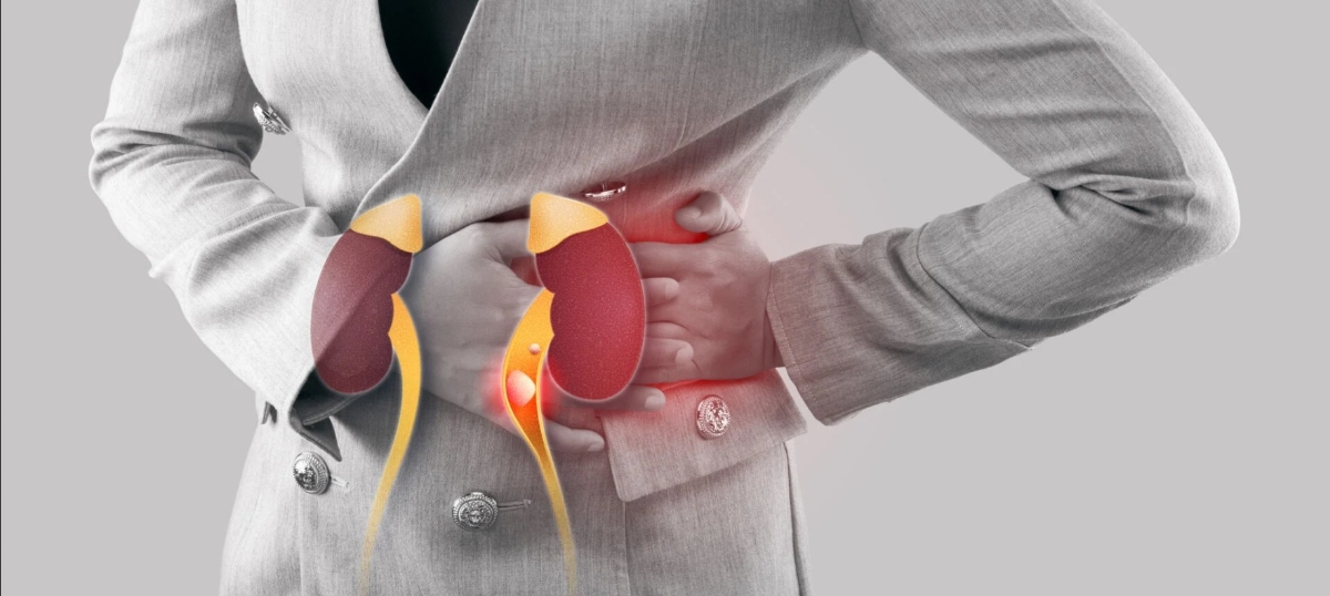 Tỉ lệ mắc sỏi thận ở nam giới có xu hướng cao hơn nữ giới khoảng 1,3 - 1,7 lần.