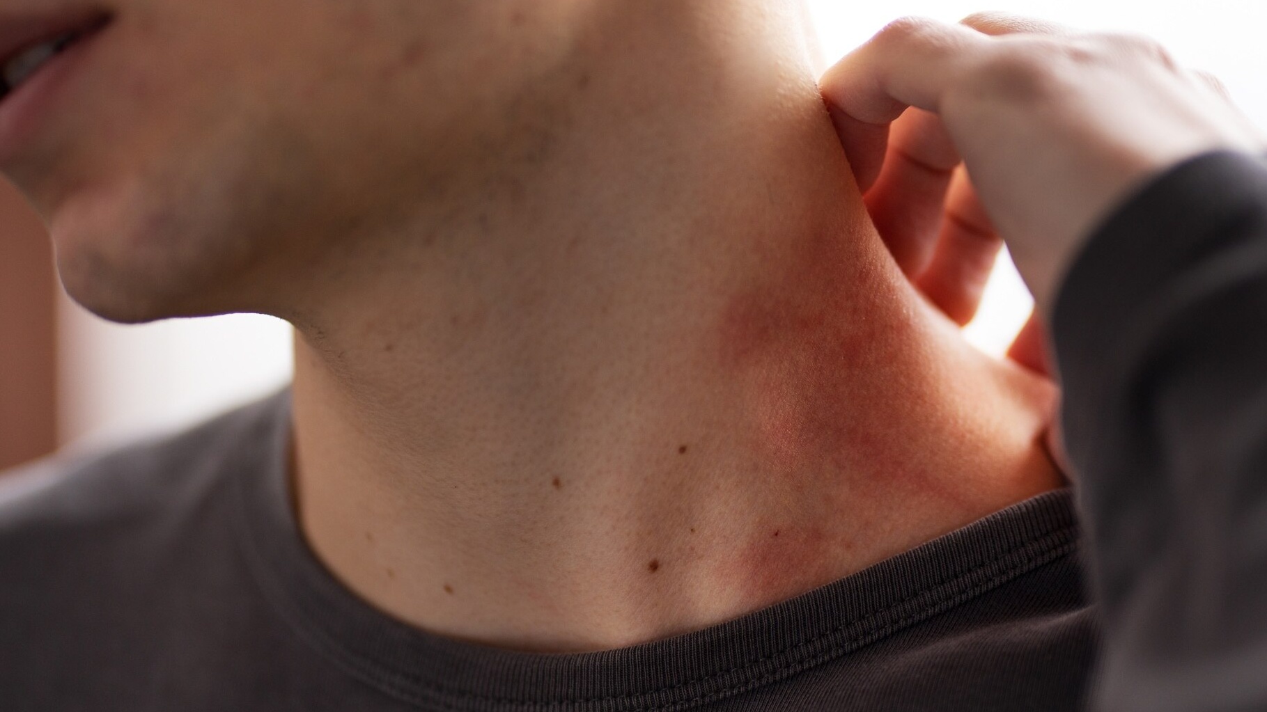 Nhiều người vẫn lầm tưởng thủy đậu là bệnh nhẹ, chỉ gây phát ban ngoài da.