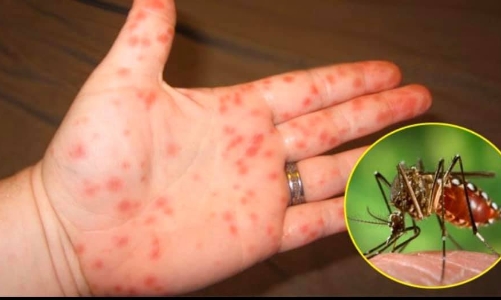 Bộ Y tế cảnh báo bệnh sốt xuất huyết và tay chân miệng gia tăng