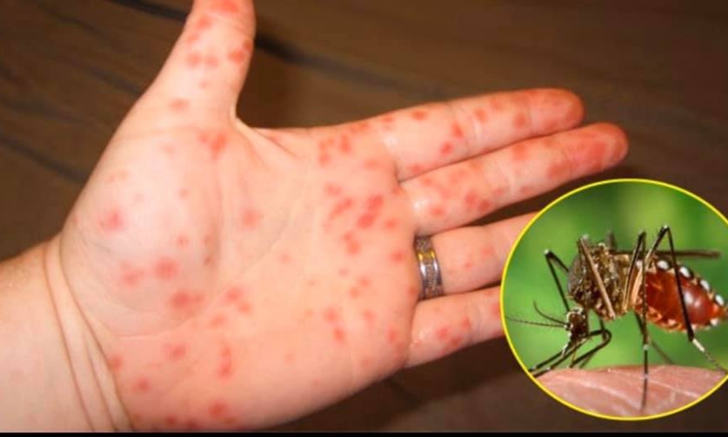 Bộ Y tế cảnh báo bệnh sốt xuất huyết và tay chân miệng gia tăng