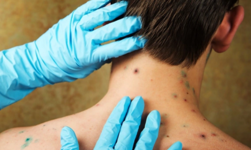 Thủy đậu ở người lớn có thể gây biến chứng nặng