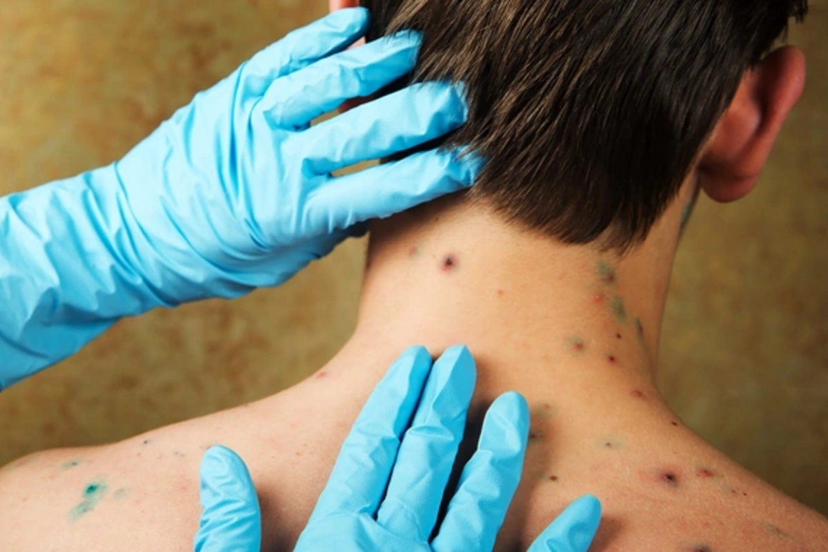 Thông thường thủy đậu diễn biến nhẹ, tuy nhiên ở người lớn, nguy cơ biến chứng nặng luôn tiềm ẩn.