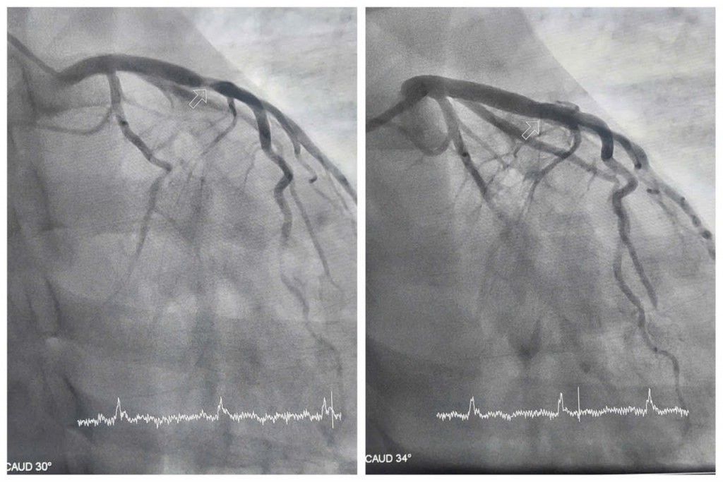 Hình ảnh hẹp tắc động mạch liên thất trước của bệnh nhân được can thiệp tái thông.