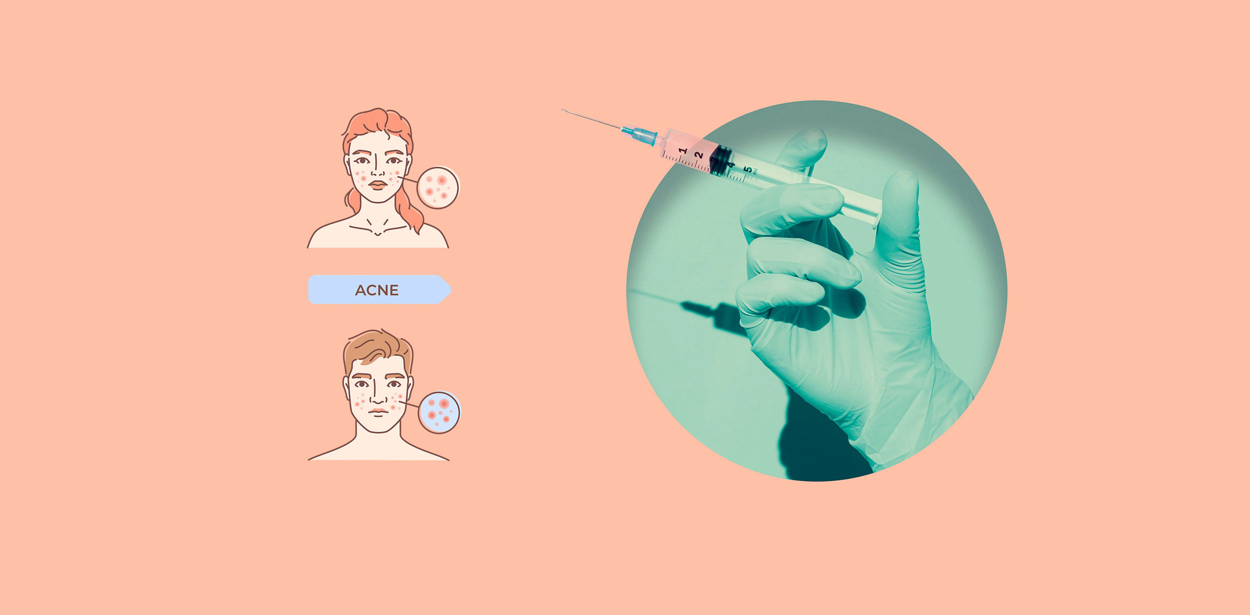 Vaccine trị mụn trứng cá có thể cung cấp một giải pháp điều trị thay thế cho các phương pháp hiện có. Ảnh: Sixth Tone