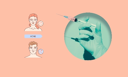 Vaccine trị mụn trứng cá có thể cung cấp một giải pháp điều trị thay thế cho các phương pháp hiện có. Ảnh: Sixth Tone