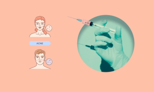 Không chỉ giới trẻ quan tâm: Vaccine trị mụn