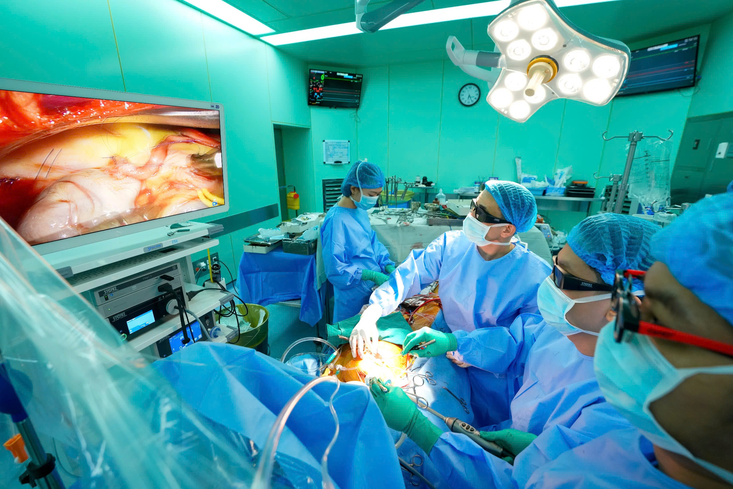 Ca phẫu thuật thay van động mạch chủ kết hợp bắc cầu mạch vành bằng kỹ thuật nội soi 3D toàn bộ.