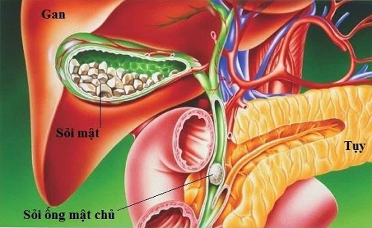 Tắc mật do sỏi ống mật chủ rất nguy hiểm với các biến chứng nghiêm trọng.