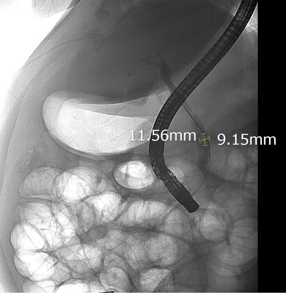 Sỏi ống mật chủ của bệnh nhân được phát hiện khi chụp DSA tại Bệnh viện Hữu nghị Việt Xô.